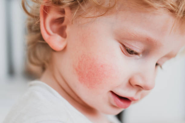A kid with skin allergy